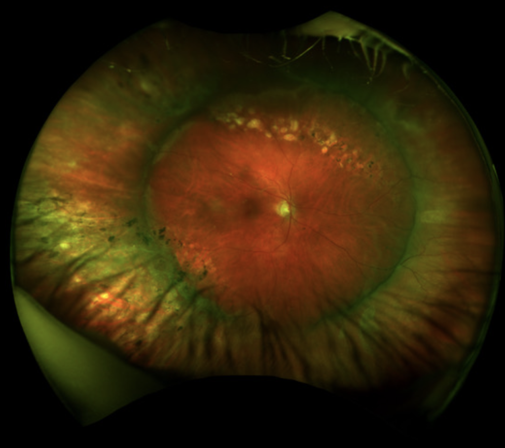 Image of an eye that previously had a retinal detachment: taken by an Optomap machine.